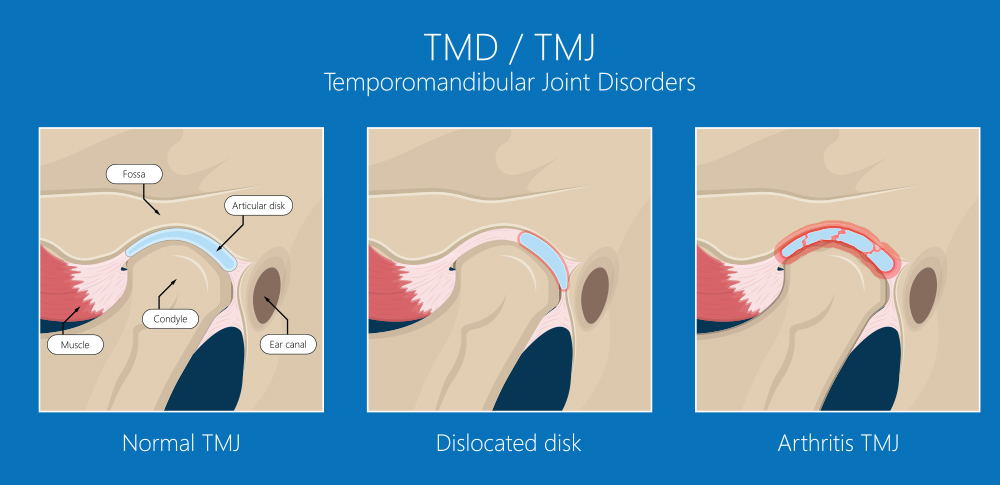 Temporomandibular Pain Treatment