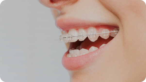 Braces in Dubai At AED 500 monthly - Braces Cost - Orthodontix