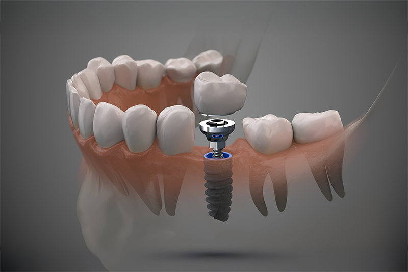 dental implant materials